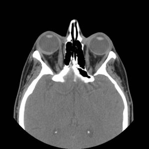 CT noncontrast axial.