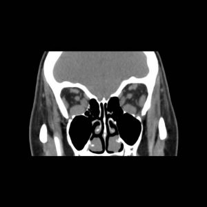 CT noncontrast coronal.