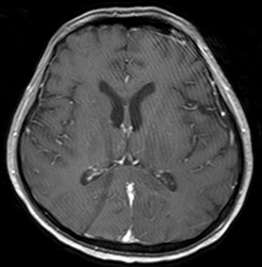 T1 axial post Gad.