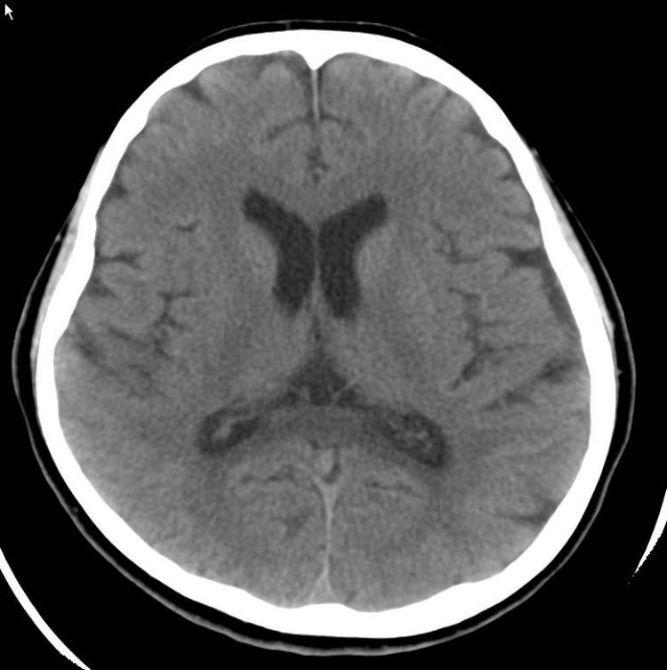 Brain CT.