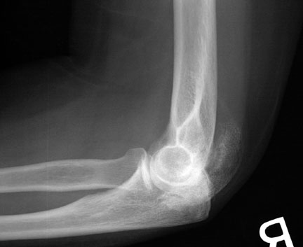 HO Elbow.