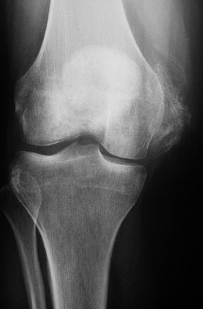 HO Knee.