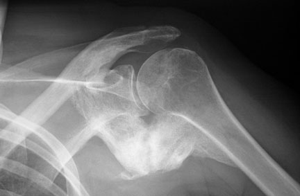 HO Shoulder.