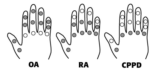 3 Hands showing hotspots for OA, RA and CPPD, respectively.