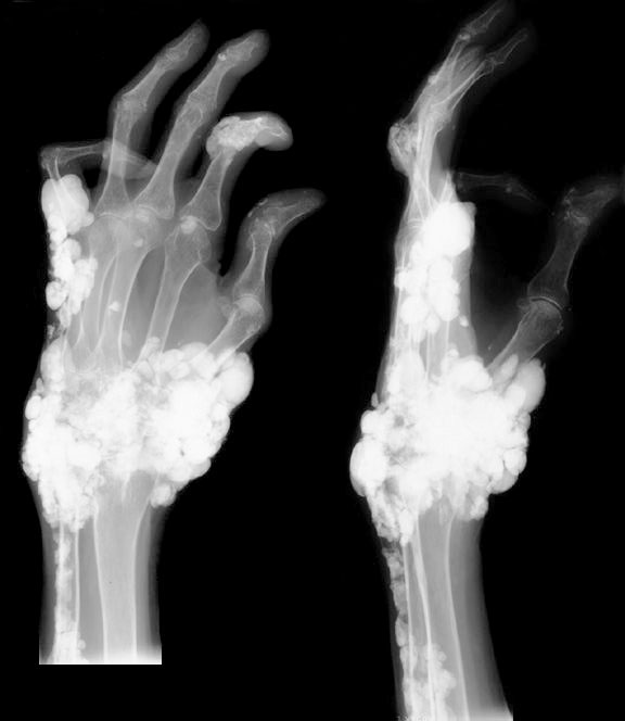 Hands Tumoral Ca.