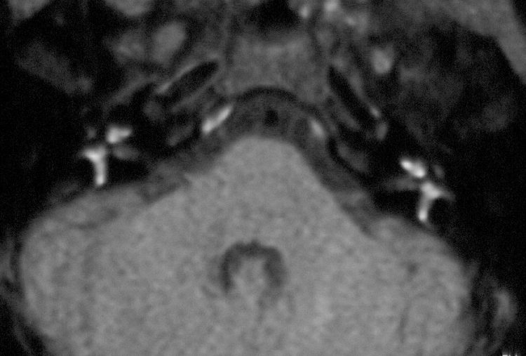 T1 Axial Noncontrast.