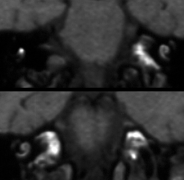 T1 Coronal Noncontrast.