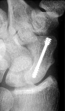 Herbert Screw.