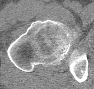 Hip CT.