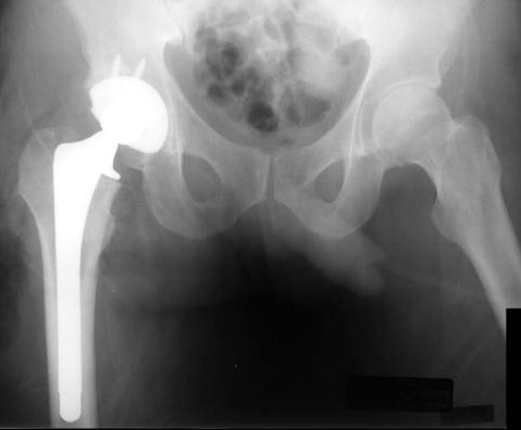 Hip Prosthesis.