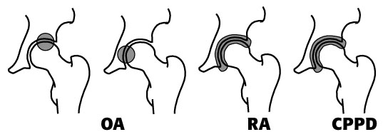 Hips showing hotspots for OA, RA, and CPPD, respectively.
