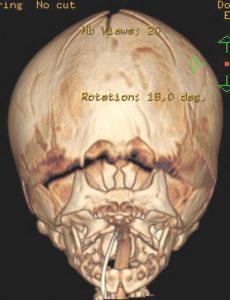 CT 3D reconstructions (anterior view).