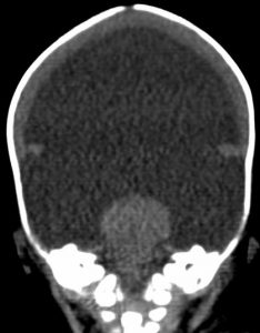 CT coronal reconstructions.