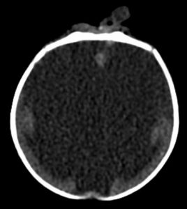 CT noncontrast.