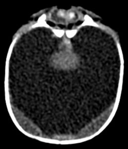 CT noncontrast.