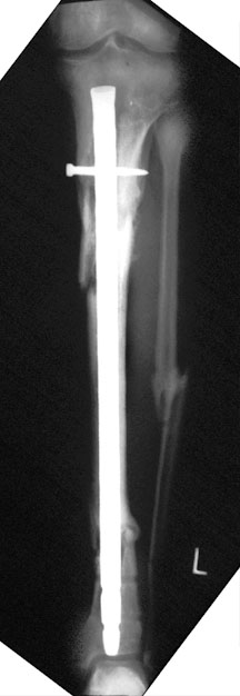 IM Tibial Nail.