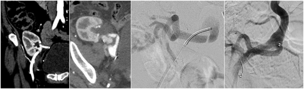 Arterial Interventions.