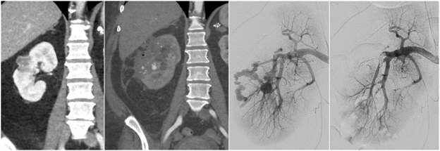 Arterial Interventions 2.