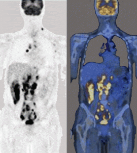 PET scan torso.