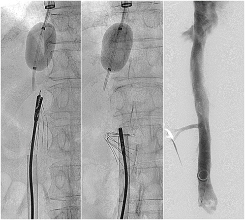 IVC placement.