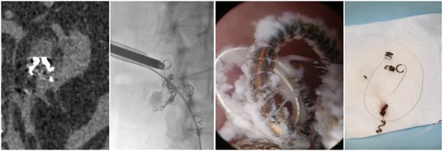 Interventional-Radiology-Operated-Endoscopy.