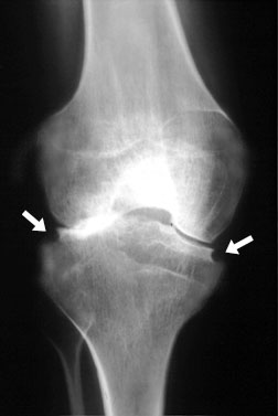 JRA Knee 1.