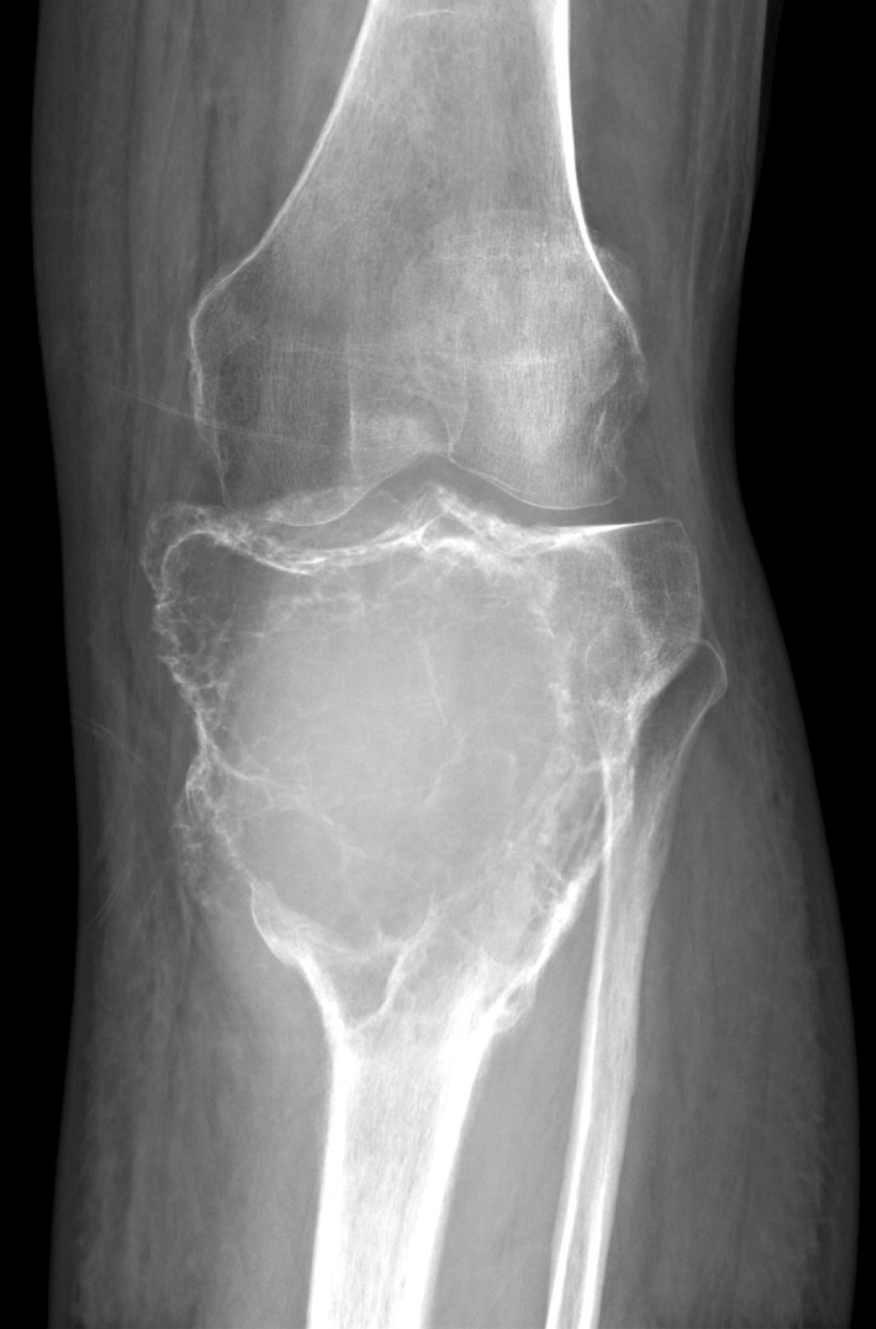 Knee CT.