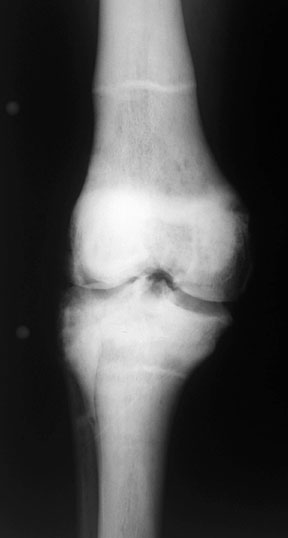 Knee AP 2.