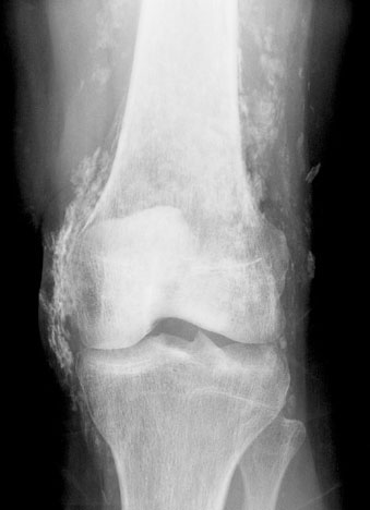 Knee AP small.