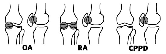 Knees showing hotspots for OA, RA, and CPPD, respectively.