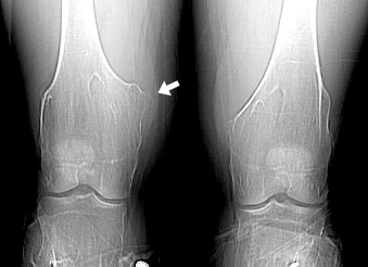 Knees Arrow.