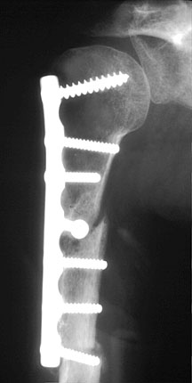 LCDC Humerus.