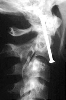 Lat Dens Screws.