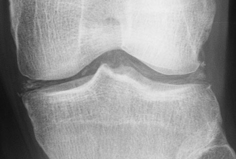 Left Knee Web.