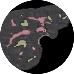 Liver segment.