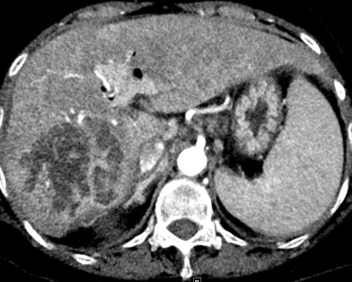 Liver Scan.