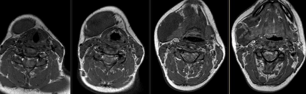 Axial T1 noncontrast.