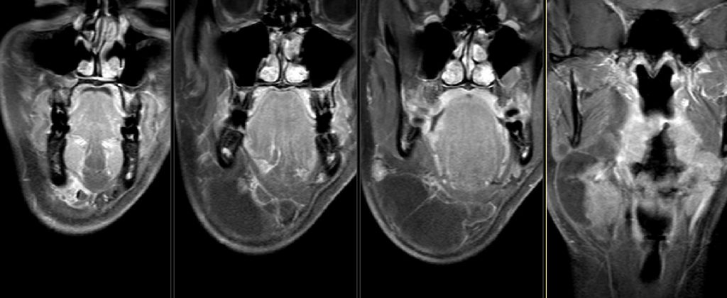Coronal T1 fat sat post Gad.