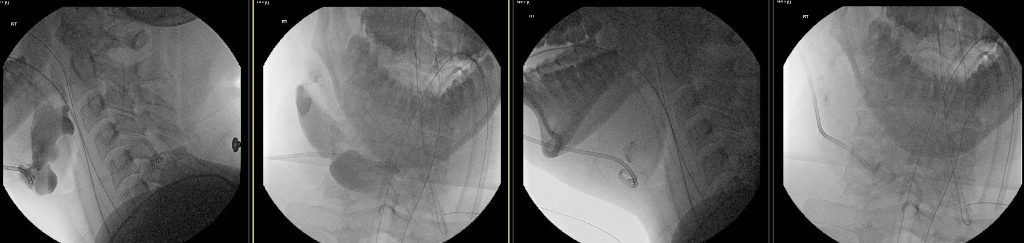 Lateral and frontal fluoroscopic images pre and post sclerotherapy procedure with Sotradecol and then ethanol.