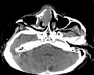 CT axial soft tissue windows.