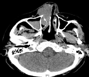 CT axial soft tissue windows.