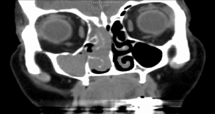 Coronal soft tissue windows.