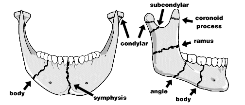 Mandible Fx.