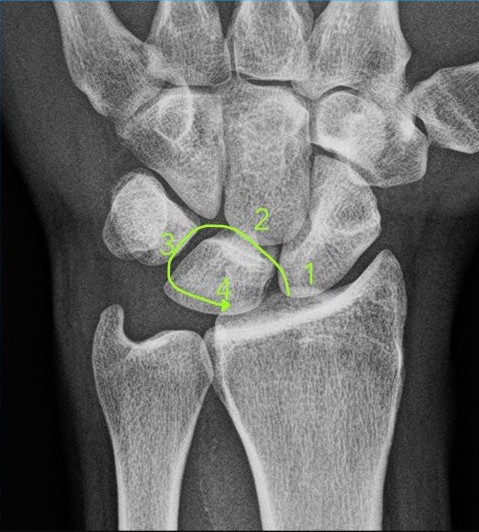 Broken wrist xray.