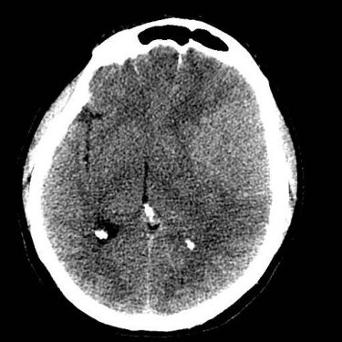 CT Noncontrast Soft Tissue Window.