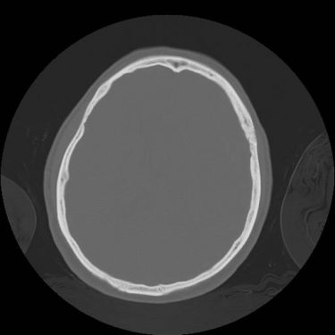 CT Noncontrast Bone Window.