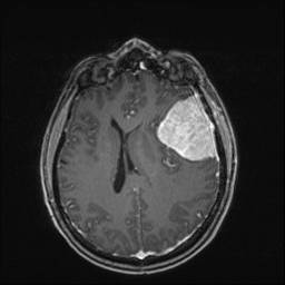 T1 Axial Post Gad.