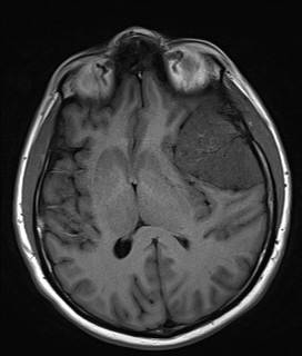 T1 Axial Noncontrast.