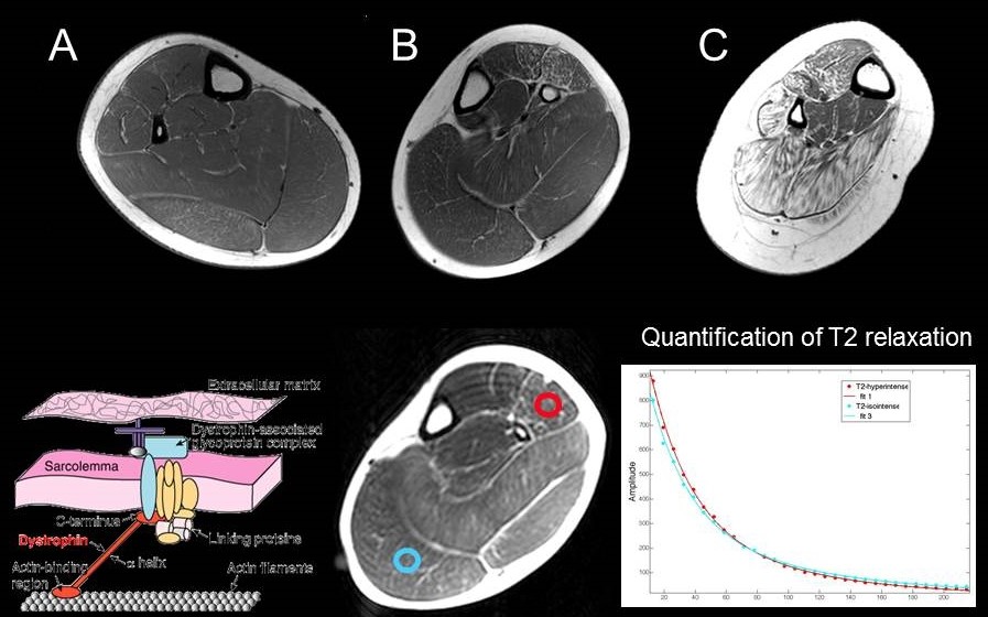 Muscular dystrophy-muscle imaging.