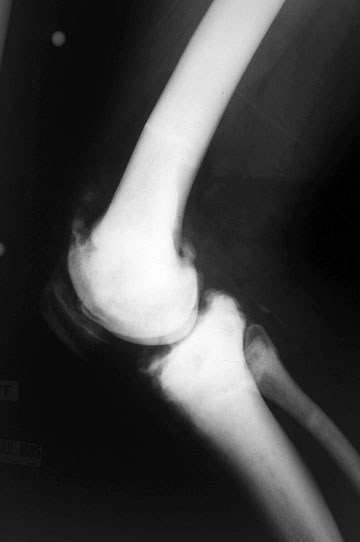 OP Knee Lat.
